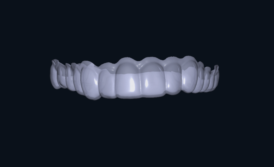 Model cyfrowy nakładki do wybielania drukowany w technologii 3D – przykład projektu