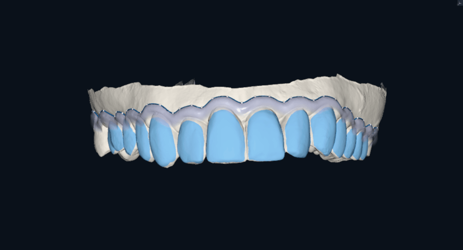Projekt CAD nakładki do wybielania drukowanej 3D – precyzyjne zbiorniczki na preparat