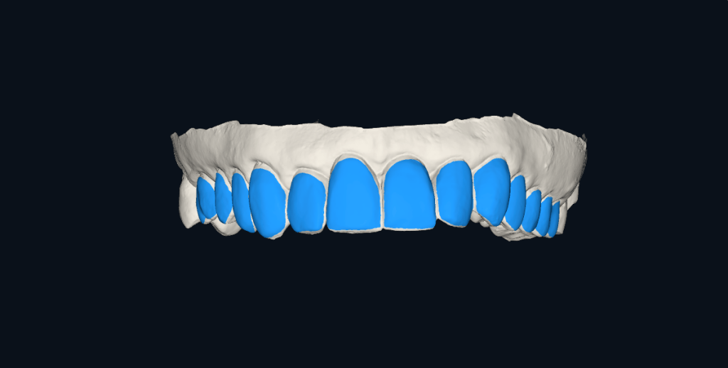 Projekt nakładki do wybielania w programie CAD – przygotowanie modelu cyfrowego